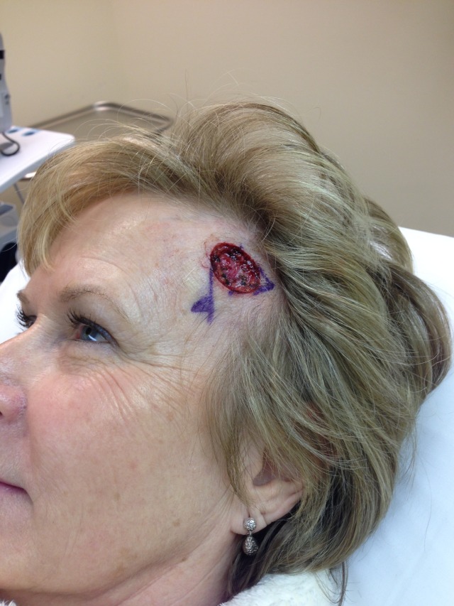 2014/2014-03 Janeen Surgery/2014-03-05 10-57-27 Basal Cell Carcinoma surgery.jpg
